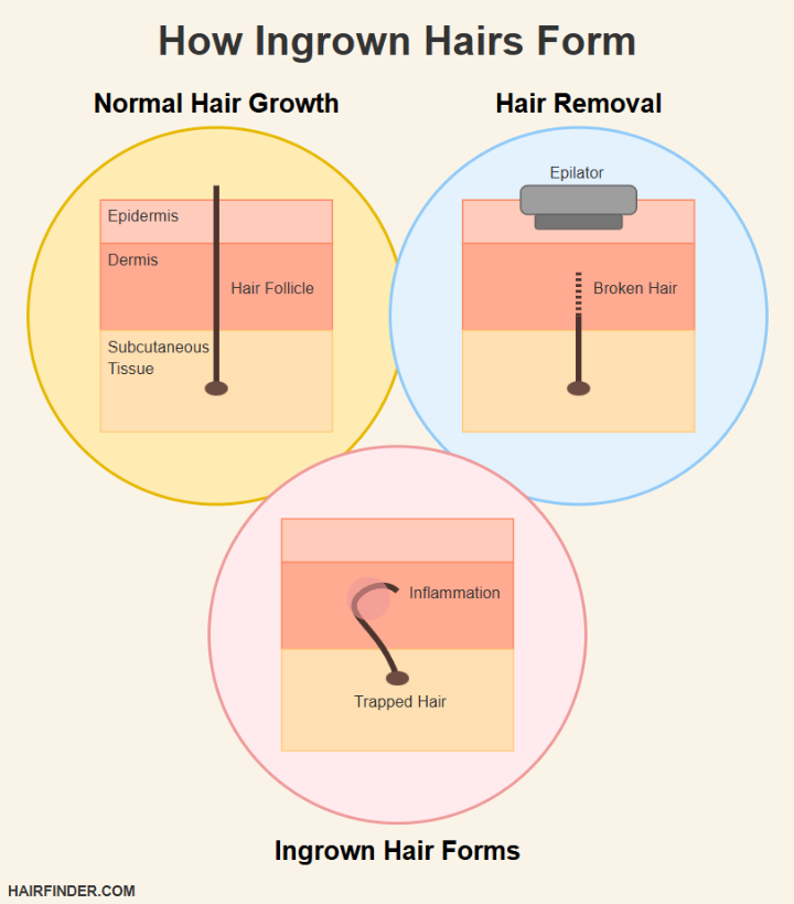 Infographic - How ingrown hairs form